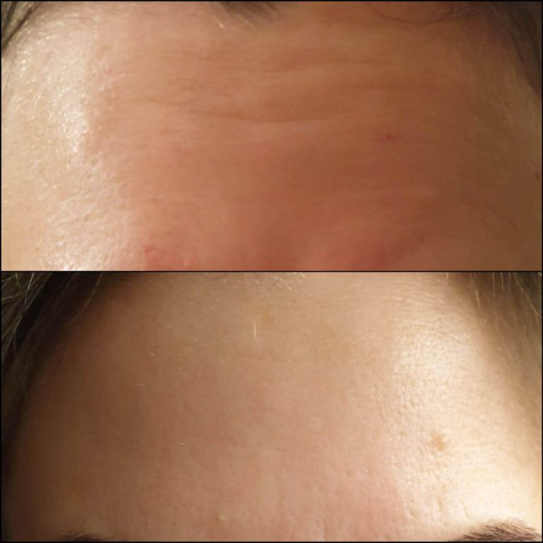 קמטי כעס והבעה